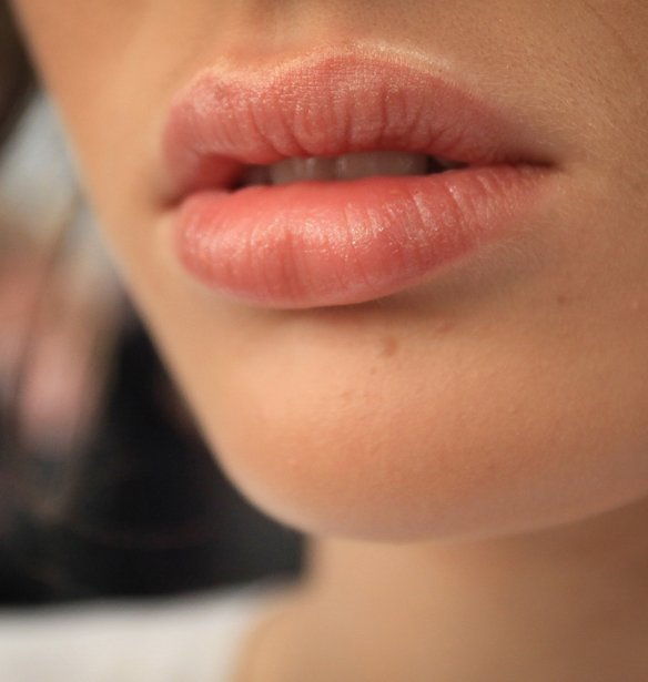 Τι είναι το Lip Flip και τι το κάνει διαφορετικό από το filler χειλιών;