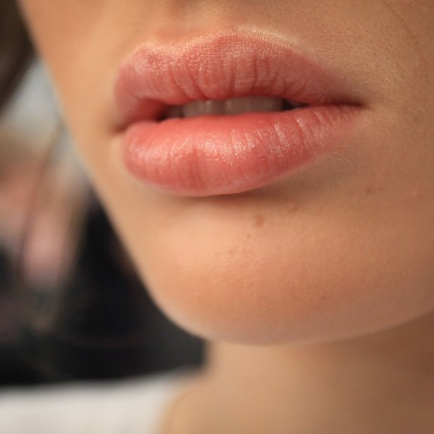 Τι είναι το Lip Flip και τι το κάνει διαφορετικό από το filler χειλιών;